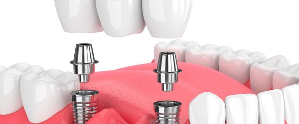 Implantes Dentales en Móstoles